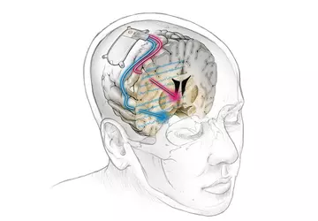 Weltweit erstes Hirnimplantat behandelt erfolgreich anhaltende ...