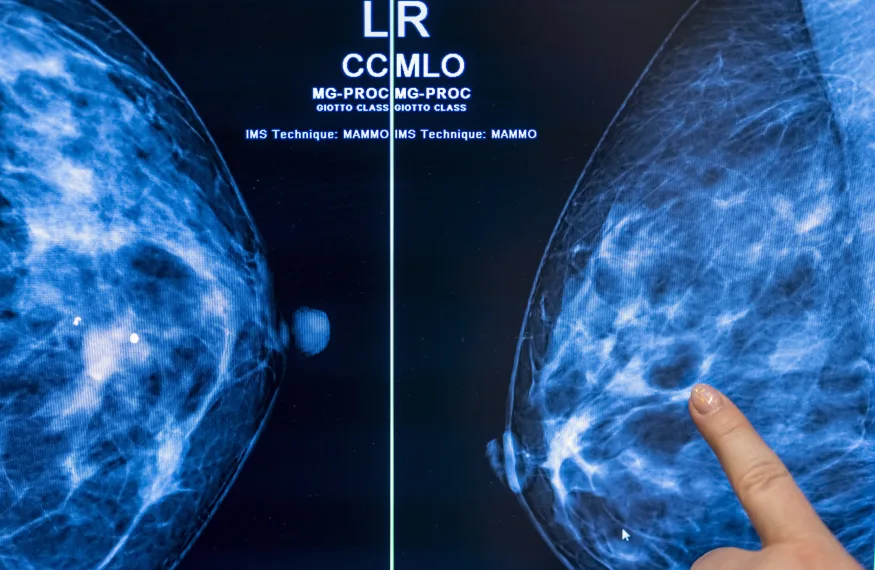 Krebsvorsorge mit künstlicher Intelligenz könnte die Arbeitsbelastung von Radiologen halbieren - Studie Krebsvorsorge mit künstlicher Intelligenz könnte die Arbeitsbelastung von Radiologen halbieren - Studie